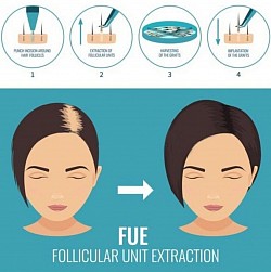 Techniques, Micro-FUE et Micro-POINT.