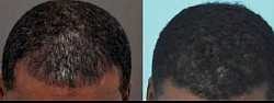 Greffe capillaire avant et 3 mois apres afro (Hamilton 2):