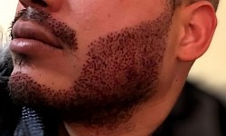 Greffe de barbe (forfait)