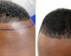 Avant/après greffe capillaire de la bordure frontale (afro).