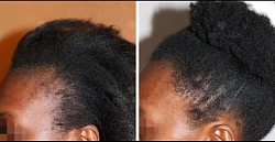 (Avant/apres)Comblement de la bordure frontale, augmentation de la densité (afro).