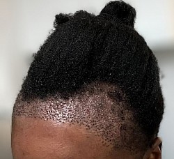 Comblement de la bordure frontale, augmentation de la densité, photo tout de suite après la greffe (afro).