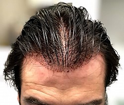 Greffe capillaire entre les cheveux.