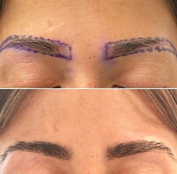Greffe de sourcils avant et 8 mois apres