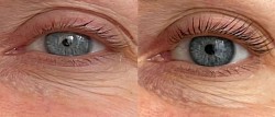Greffe de cils avant et 3 mois apres